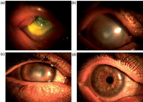 Case 2 – (a) Right eye at presentation, corneal infiltrate and ...