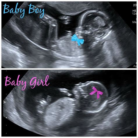 baby at 14 weeks ultrasound gender - Kandace Bunn