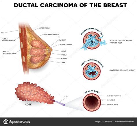 Ductal Carcinoma Breast Detailed Medical Illustration Ductal Cancer Situ Invasive Stock Vector ...