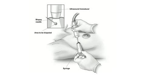 Fine-Needle Aspiration Cytology (FNAC) - Advance Breast Clinic