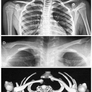 (PDF) Management of sternoclavicular dislocation in young children ...