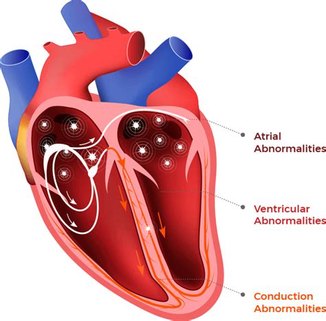 Heart Arrythmia Types & Irregular Heartbeats in Dilated Cardiomyopathy