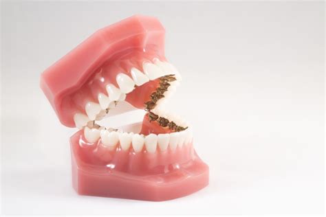 Lingual braces: a revolutionary way of applying a brace! - Medical Bulletin