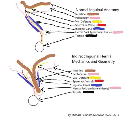 Hernia FAQ: What is a hernia? | Learn More | Boston Hernia