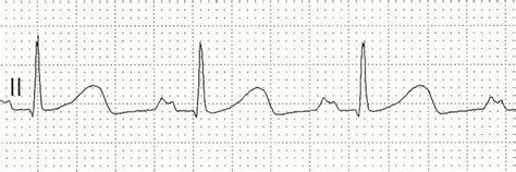 P wave • LITFL • ECG Library Basics