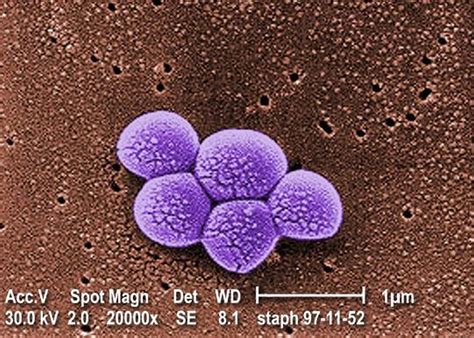 MRSA Infection - Symptoms, Diagnosis, MRSA Skin Infection Treatment