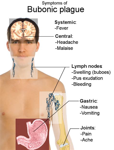 File:Symptoms of bubonic plague.svg - Wikimedia Commons