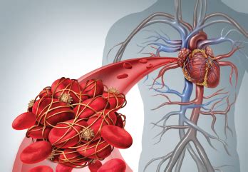 Risk Assessment & Treatment in Antiphospholipid Syndrome Patients - The Rheumatologist