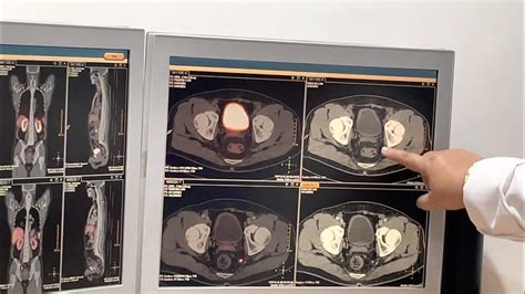 Video 1: PSMA-PET Scan results after my Lutetium-177 (LU177) prostate ...