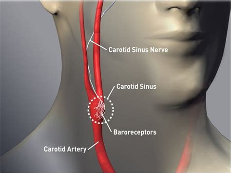 CVRx’s Barostim Neo Neuromodulation System, US