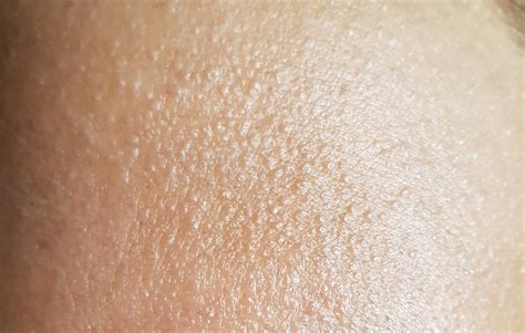 [Skin Concerns] Tiny flesh colored bumps on face : r/SkincareAddiction