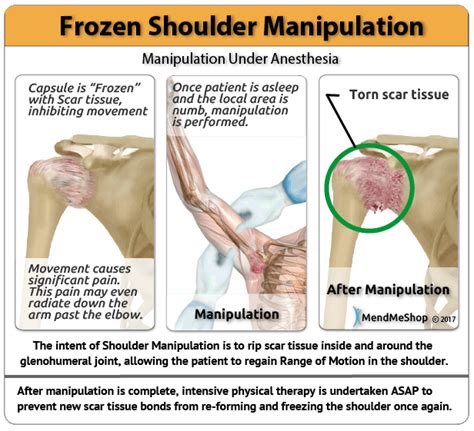 Frozen Shoulder Surgery & Rehabilitation