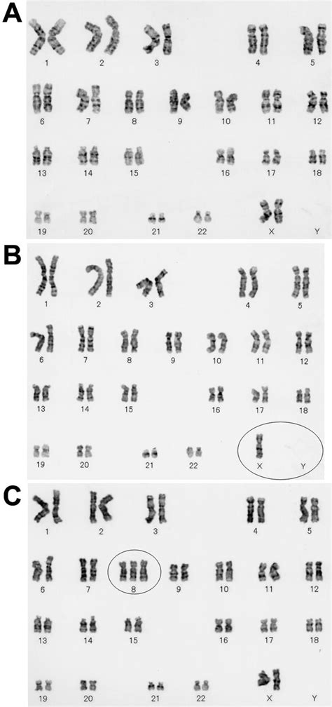 Examples of karyotypes of cultured human corneal endothelial cells ...