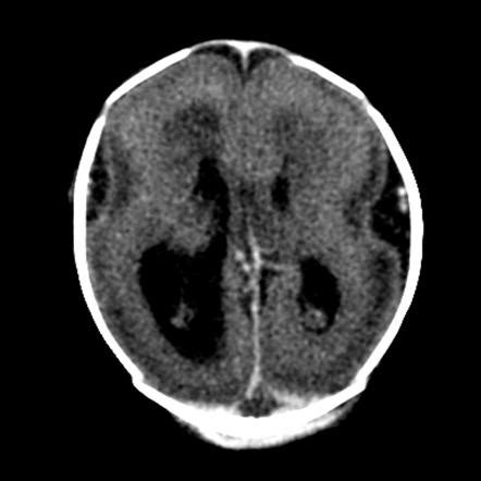 Lissencephaly Mri