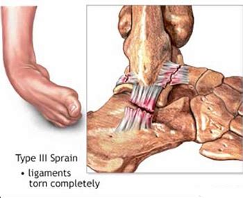 Ankle Ligament Reconstruction For Ankle Instability | Spine & Orthopedic Center