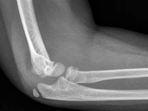 Pediatric Terrible Triad Injury of the Elbow: A Rare and Eas... : JBJS Case Connector