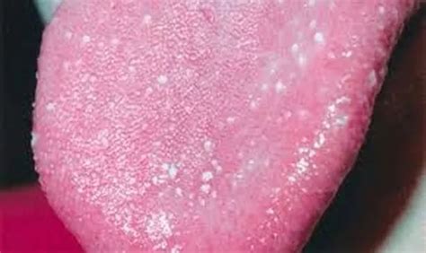 Small bumps on tongue identified by doctors as potential coronavirus symptom - Mirror Online