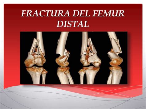 Fractura del femur distal