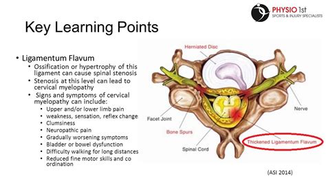 Image result for ligamentum flavum | Spinal stenosis, Nerve weakness, Lower limb