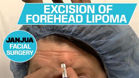 EXCISION OF FOREHEAD LIPOMA - DR. TANVEER JANJUA - NEW JERSEY - YouTube