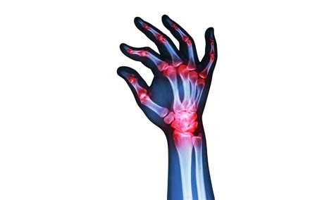 Rheumatoid Arthritis: ರುಮಟಾಯ್ಡ್‌ ಆರ್ಥರೈಟಿಸ್‌ ಬಗ್ಗೆ ನಾವು ತಿಳಿಯಬೇಕಾದದ್ದೇನು? - Vistara News