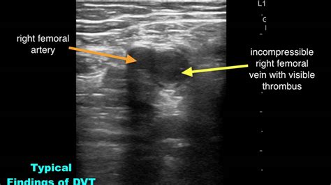 Lower Extremity DVT Typical Findings - YouTube