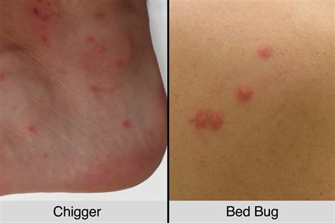 Chigger Bites vs. Bed Bug Bites: How to tell the Difference | The Healthy