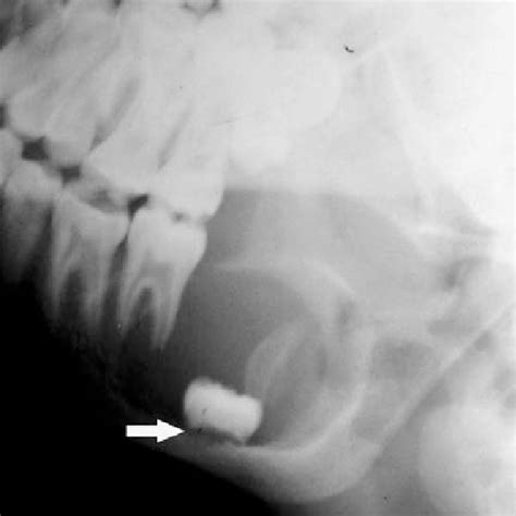 Lateral Radicular Cyst