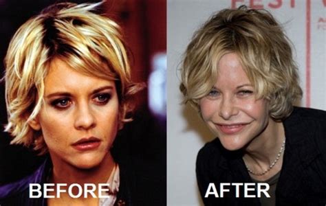 Meg Ryan Before And After Eye Surgery