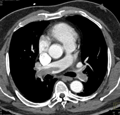 Extensive Pulmonary Embolism - Chest Case Studies - CTisus CT Scanning