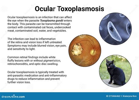 Ocular Toxoplasmosis, Retinal Scar Caused By A Toxoplasma Gondii Infection, Scientific ...