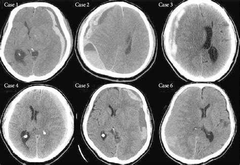 Dexamethasone For Chronic Subdural Hematoma NEJM, 45% OFF