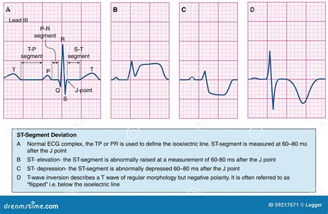 Normal And Abnormal Ecg Traces Cartoon Vector | CartoonDealer.com #59217571