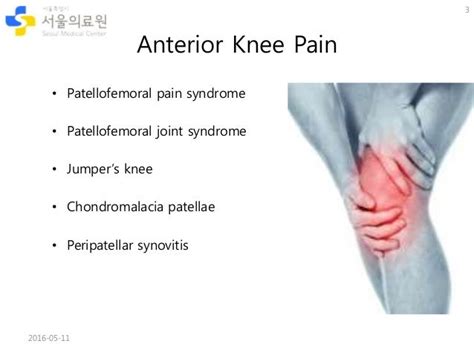 Patellofemoral Pain Syndrome