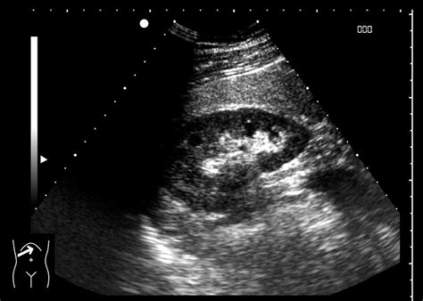 Kidney Ultrasound