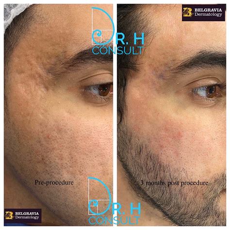 Acne Scar Laser Treatment & Removal London | Dr H Consult