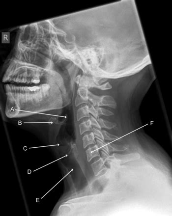 Radiograph showing the soft tissues of the neck: lateral view | The BMJ