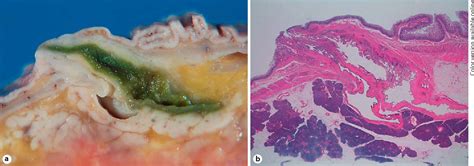 Figure 1 from Major Duodenal Papilla and Its Normal Anatomy | Semantic Scholar