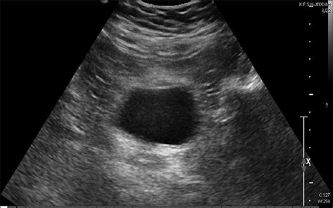 Normal Pelvic Ultrasound