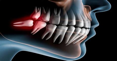 Third molar surgery: the patient and the clinician's perspective