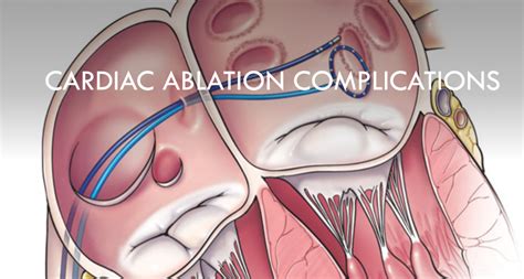 emDOCs.net – Emergency Medicine EducationComplications of cardiac ...