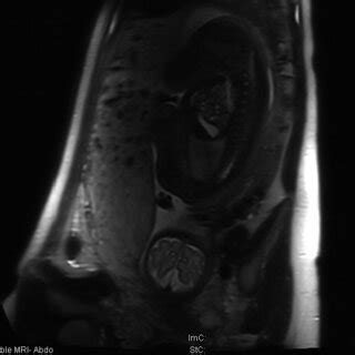 MRI sagittal view of the uterus at 32 weeks demonstrating a thickened... | Download Scientific ...