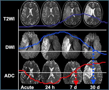 The Radiology Assistant : Imaging in Acute Stroke