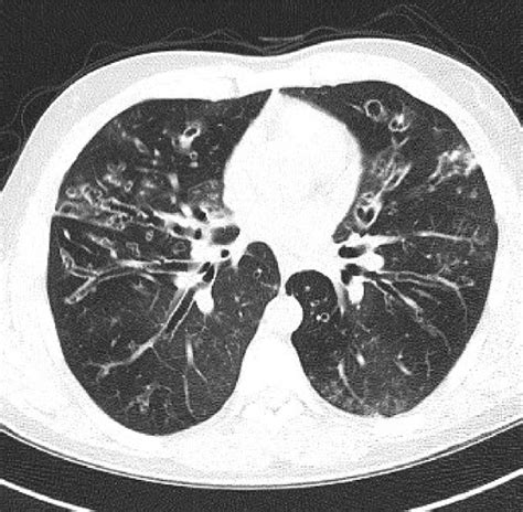 Tram-track sign seen in cylindrical bronchiectasis on the chest CT scan... | Download Scientific ...