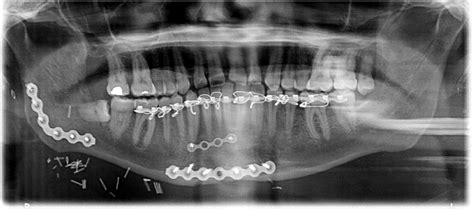 Submandibular Fossa Radiograph