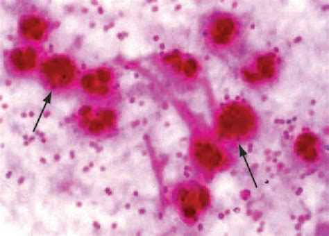 Figure 2 from Moraxella catarrhalis, a human respiratory tract pathogen. | Semantic Scholar