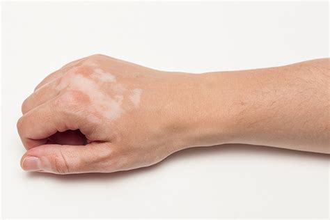 Vitiligo In Children – Prevention And Treatment