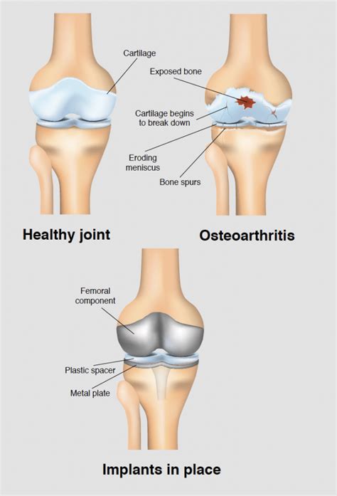 Sponsor For Knee Replacement Surgery | ubicaciondepersonas.cdmx.gob.mx