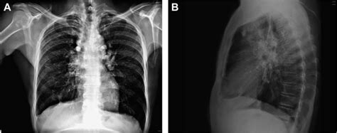 Eggshell Calcification of Lymph Nodes in Silicosis - The American ...