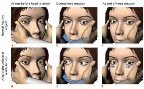 Anatomía y Neurofisiología Vestibular | Adam Faliq